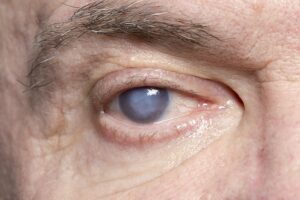 Read more about the article Cataracts Treatment: How to Improve Your Vision Today